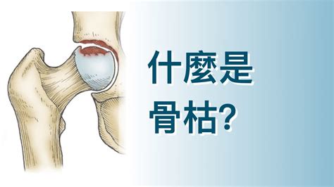 骨枯手術費用|髖關節骨枯：成因與治療